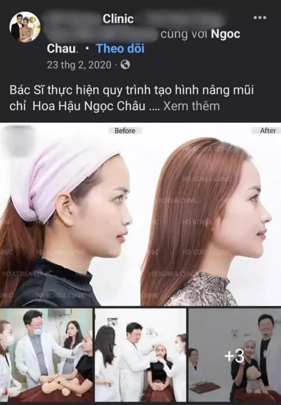 Ngọc Châu bị 'khui' phát ngôn bất nhất, lộ rõ ảnh can thiệp phẫu thuật thẩm mỹ