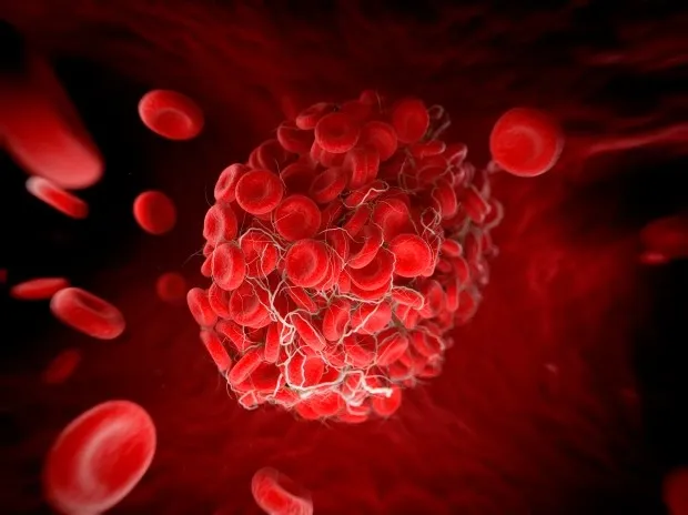 Phát hiện một biến chứng của Covid kéo dài có thể nguy hiểm tính mạng