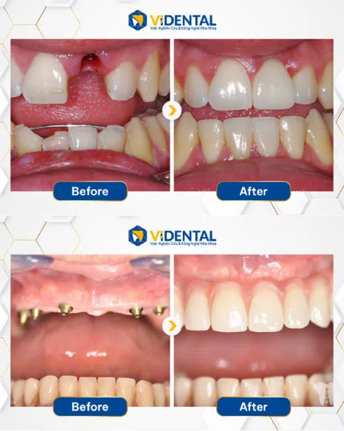5 Tiêu chuẩn vàng trồng răng Implant không đau, bền đẹp tại ViDental