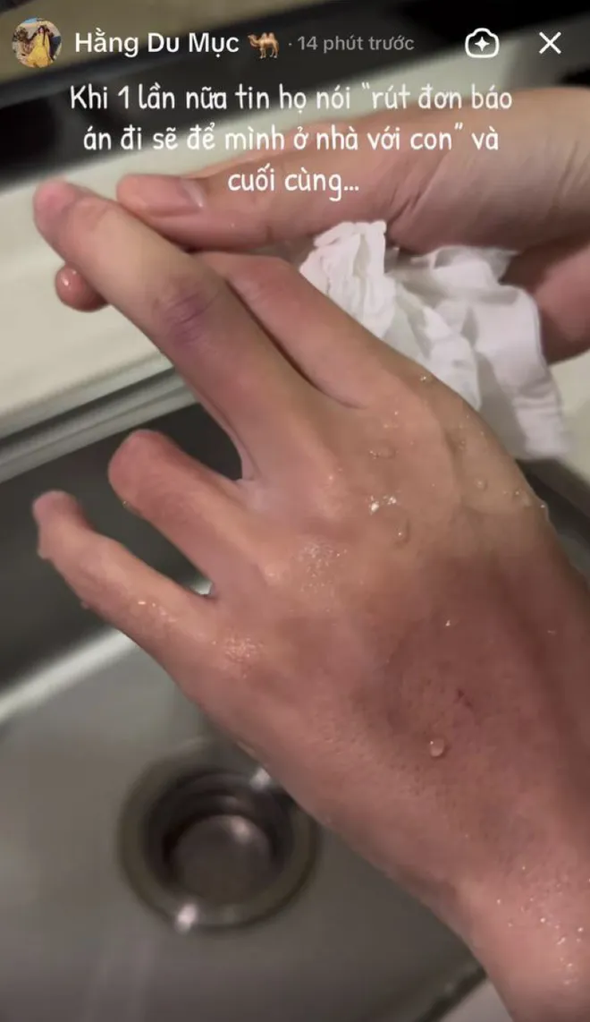 hang-du-muc-an-y-vet-bam-tren-co-the-khong-phai-lan-dau-chong-livestream-xac-nhan-co-xo-xat-voi-vo-3