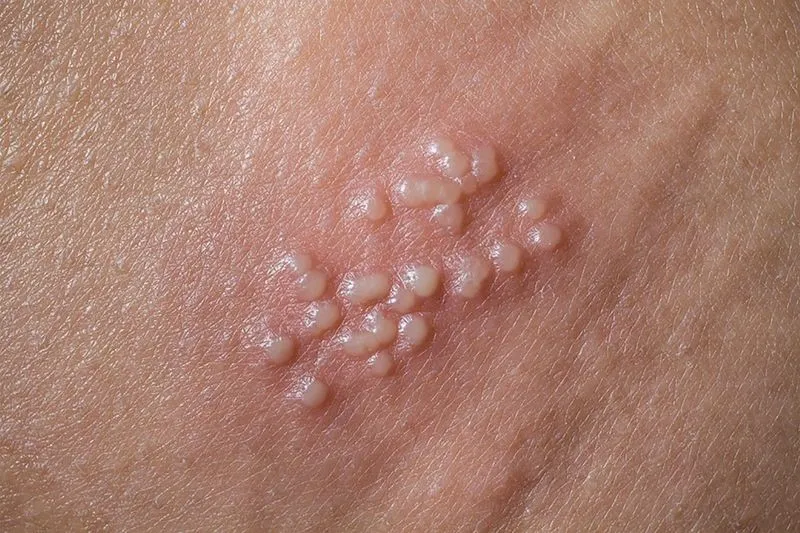 uong-say-roi-hon-nguoi-la-trong-bar-thanh-nien-30-tuoi-o-ha-noi-phat-hien-mac-can-benh-ma-nhieu-nguoi-khiep-so (15)