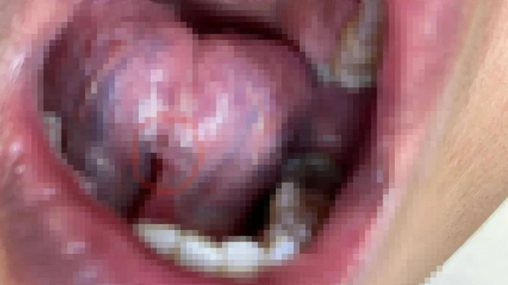 uong-say-roi-hon-nguoi-la-trong-bar-thanh-nien-30-tuoi-o-ha-noi-phat-hien-mac-can-benh-ma-nhieu-nguoi-khiep-so (4)