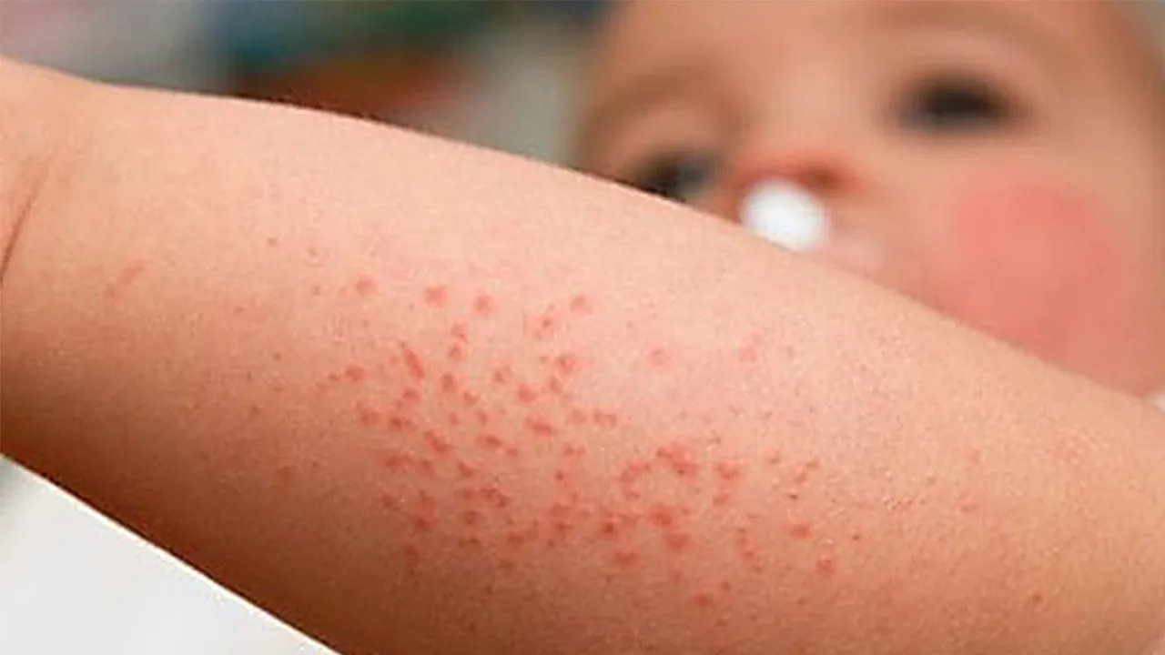 Ha-Noi-ghi-nhan-dich-benh-nong-nhat-hon-400-ca-mot-tuan