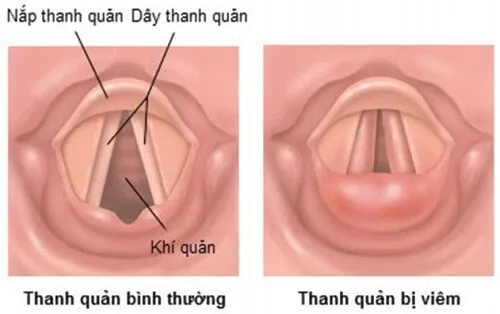 nguyen-nhan-va-trieu-chung-viem-nap-thanh-quan-o-tre-em-3