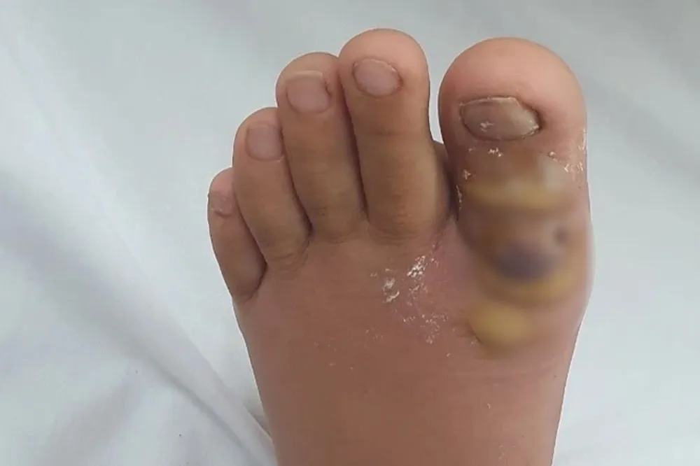 nhiem-khuan-tay-chan