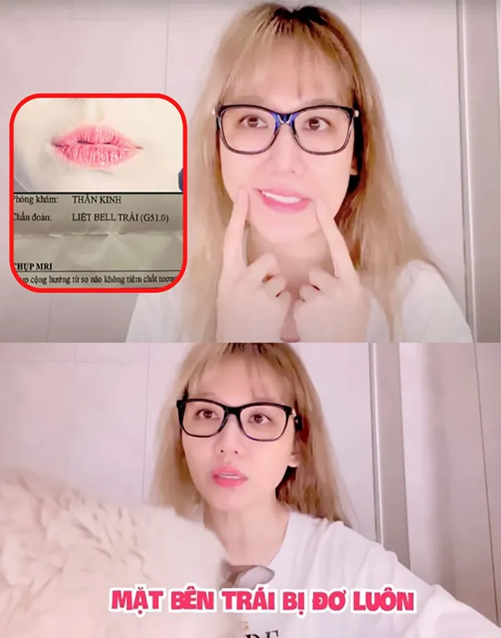 ban-than-tran-thanh-bi-liet-nua-mat-nguy-co-dot-quy-4