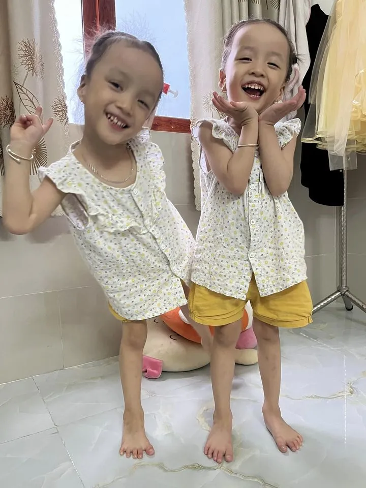 cap-song-sinh-dinh-lien-duoc-tach-roi-sau-hon-3-nam-hien-ra-sao