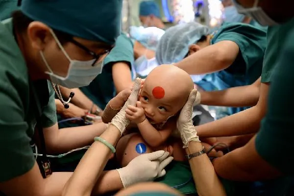 cap-song-sinh-dinh-lien-duoc-tach-roi-sau-hon-3-nam-hien-ra-sao-6