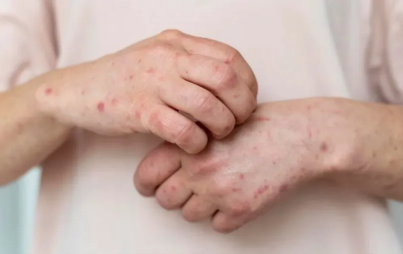 ca-mac-dau-mua-khi-dau-tien-tu-vong-tai-tphcm-1