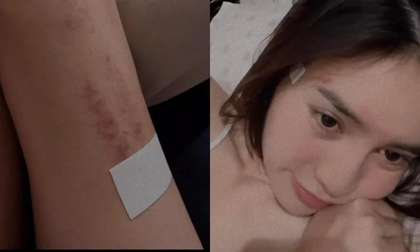 yeah1-ninh-duong-lan-ngoc-de-lo-vet-bam-tim (3)