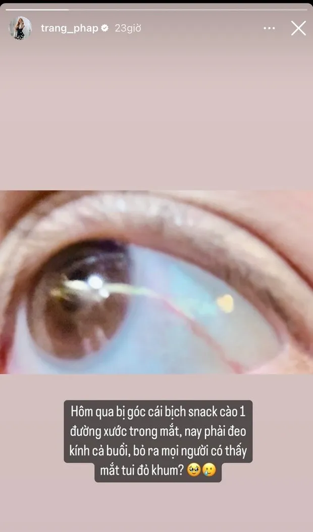 trang-phap-bi-vet-xuoc-dai-o-mat (6)