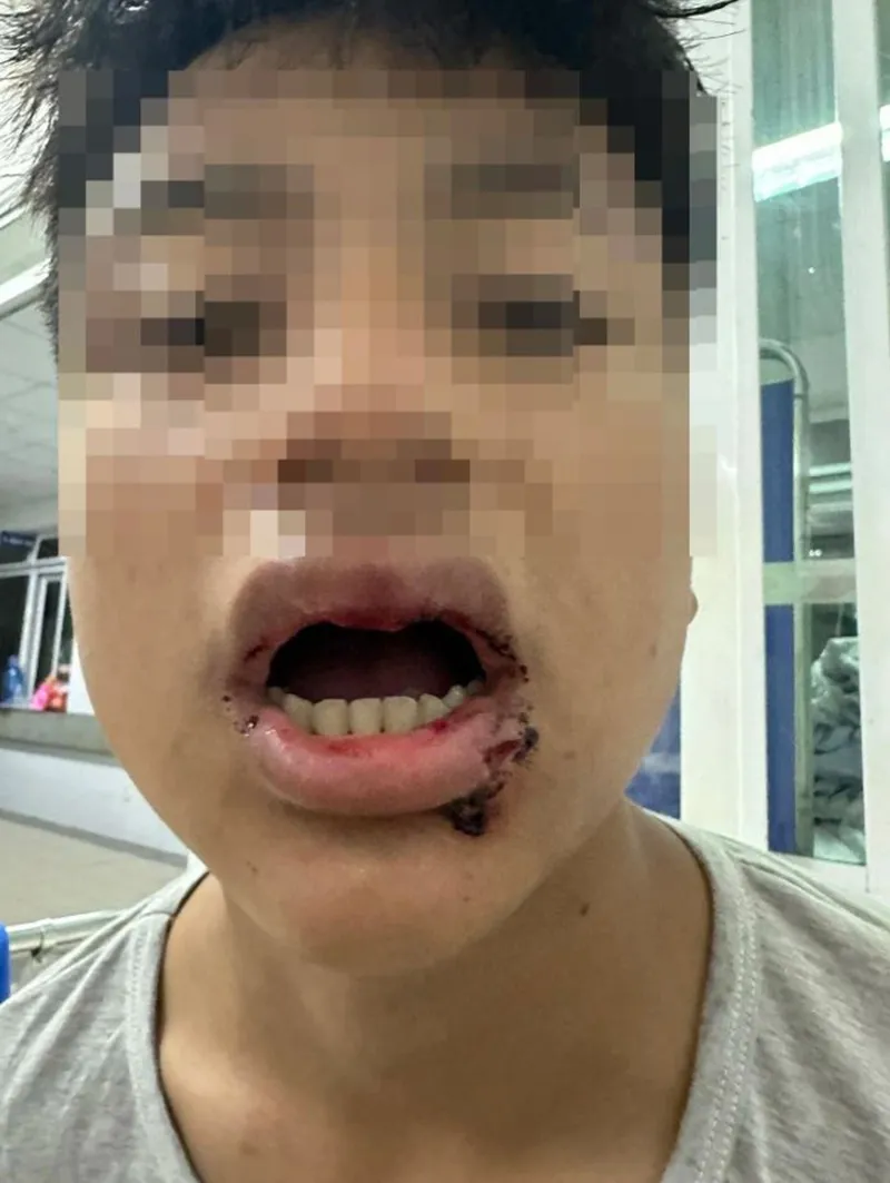 nam-sinh-lop-9-bi-nhom-nguoi-la-mat-tan-cong-khi-di-tam-bien-2