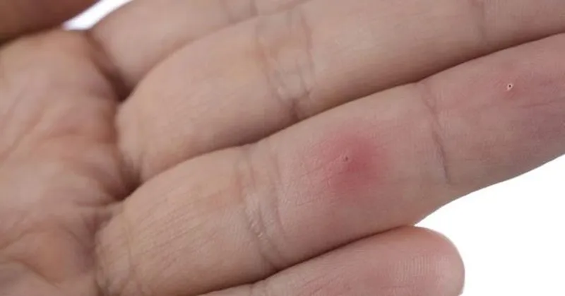 nu-cong-nhan-bi-kim-dam-xuyen-ngon-tay-1