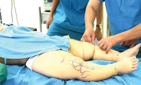 Những bài tập khắc phục chân vòng kiềng lâu năm hiệu quả nhất