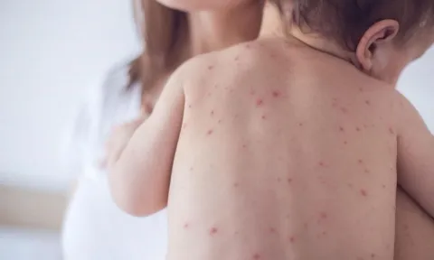 WHO công bố tình trạng y tế toàn cầu đối với bệnh đậu mùa khỉ: Bộ Y tế họp khẩn