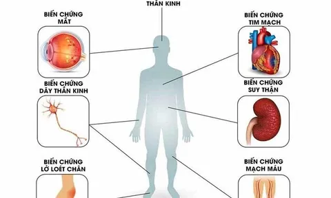 BoniDiabet – Bí quyết xua tan nỗi ám ảnh mang tên biến chứng tiểu đường
