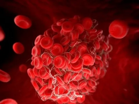 Phát hiện một biến chứng của Covid kéo dài có thể nguy hiểm tính mạng