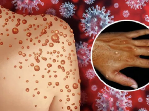 NÓNG: WHO công bố tên 2 biến chủng đậu mùa khỉ đang lưu hành 