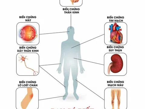 BoniDiabet – Bí quyết xua tan nỗi ám ảnh mang tên biến chứng tiểu đường