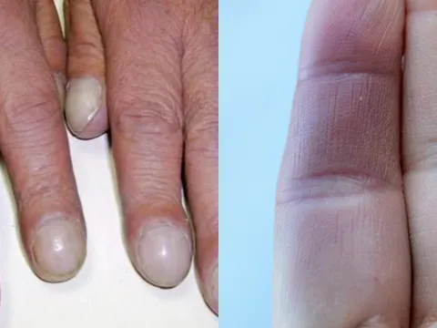 2 dấu hiệu nhỏ trên ngón tay tiết lộ bệnh nguy hiểm
