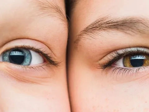 5 lý do khiến da mắt của bạn nhiều nếp nhăn sớm, đừng quên thay đổi ngay!
