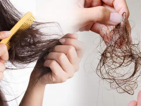 Cơ thể thiếu chất gì khiến tóc bị rụng nhiều? Càng để lâu càng nguy hiểm