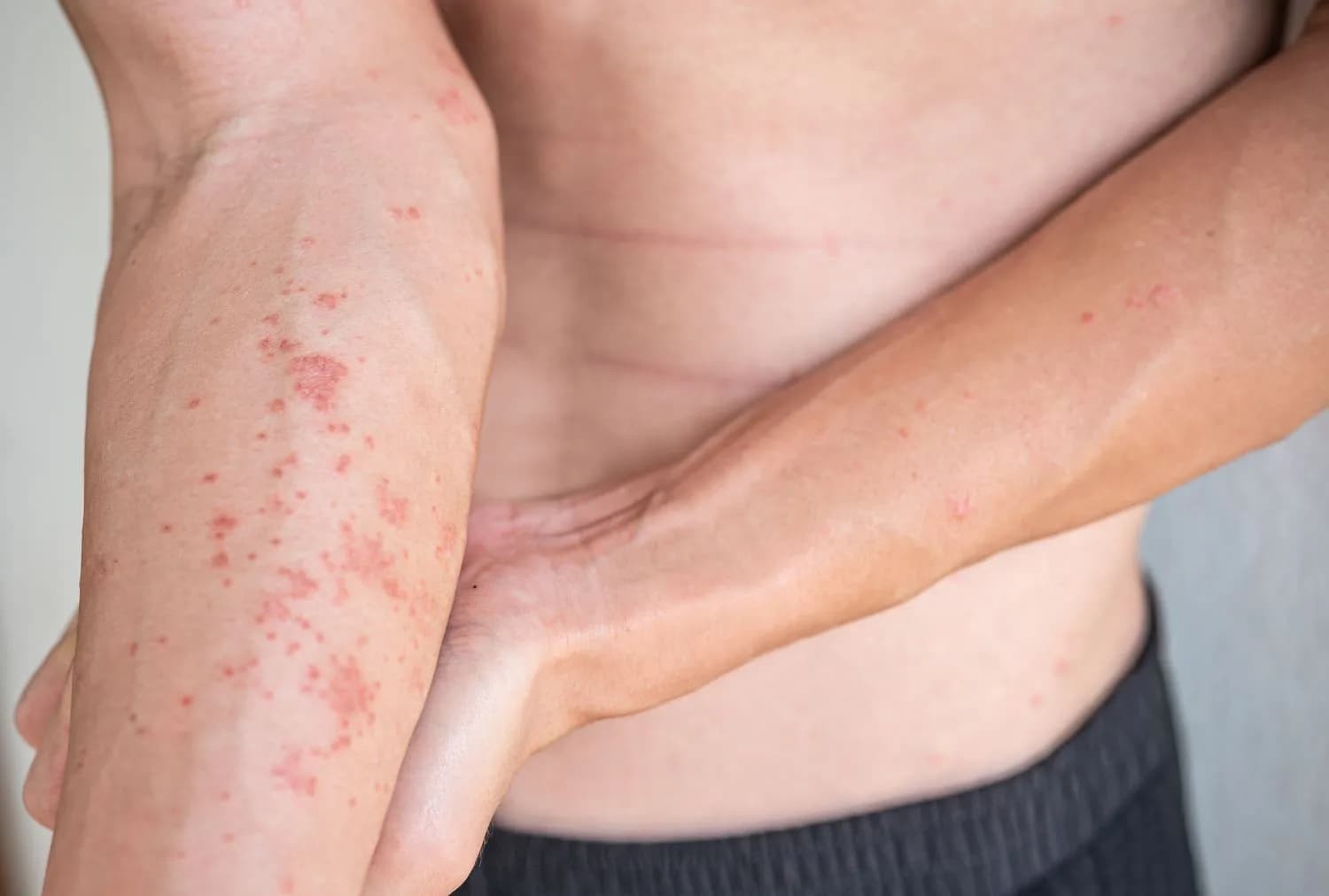 Nếu xảy ra tình trạng kích ứng, mẩn đỏ da khi sử dụng củ ráy cần đến bệnh viện thăm khám