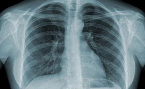 X - quang ngực, phổi là phương pháp hiệu quả để xác định nguyên nhân gây nấc cụt
