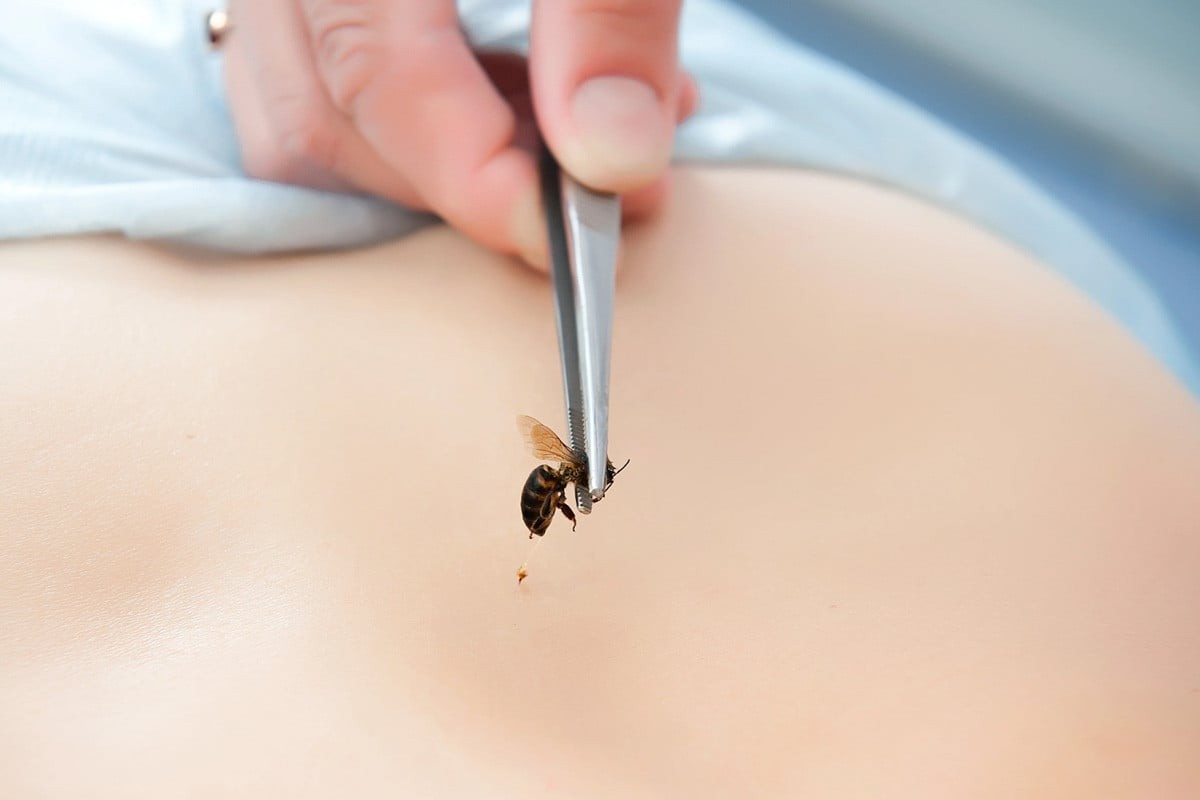 Bạn nên dùng các vật dụng để lấy kim ong đốt ra tránh lây sang những vùng da khác