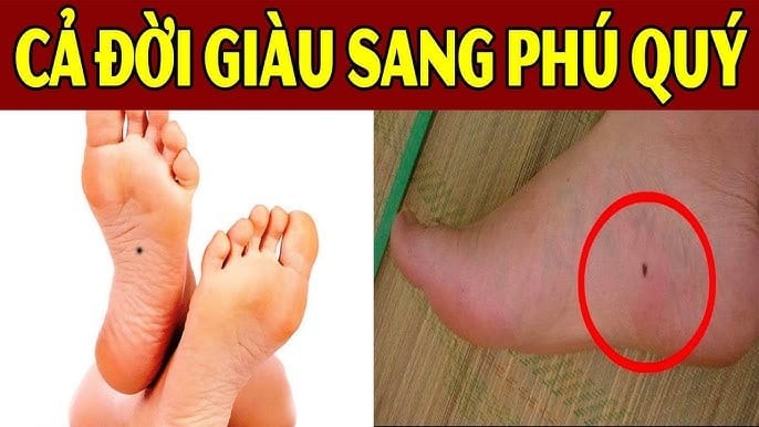 Nốt ruồi hút bạc tỷ ai có thật đáng chúc mừng