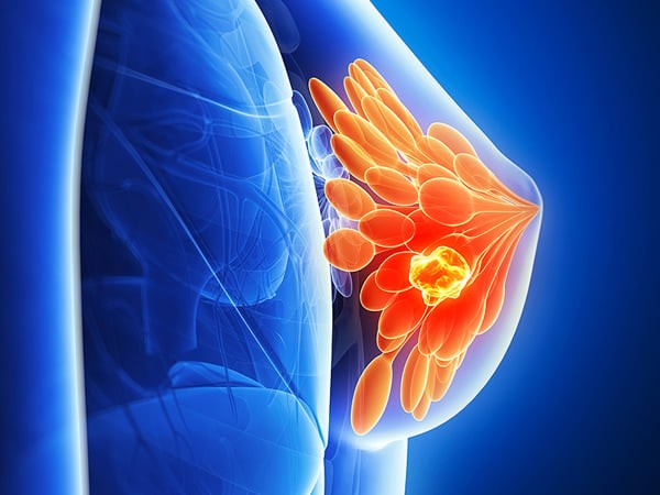 2 thói quen cực xấu của chồng khiến vợ dễ bị ung thư vú: Bỏ ngay kẻo hại cả nhà