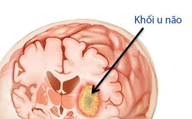 Dấu hiệu cảnh báo bệnh u não sớm