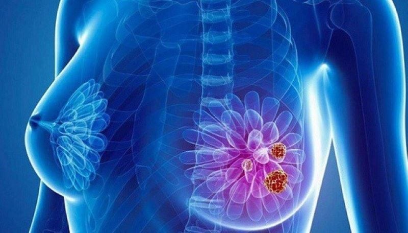 Ung thư vú ngày càng phổ biến