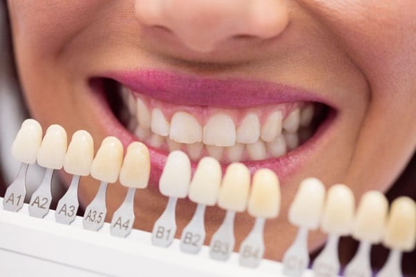 Bọc răng sứ là phương pháp rất phổ biến trong nha khoa thẩm mỹ