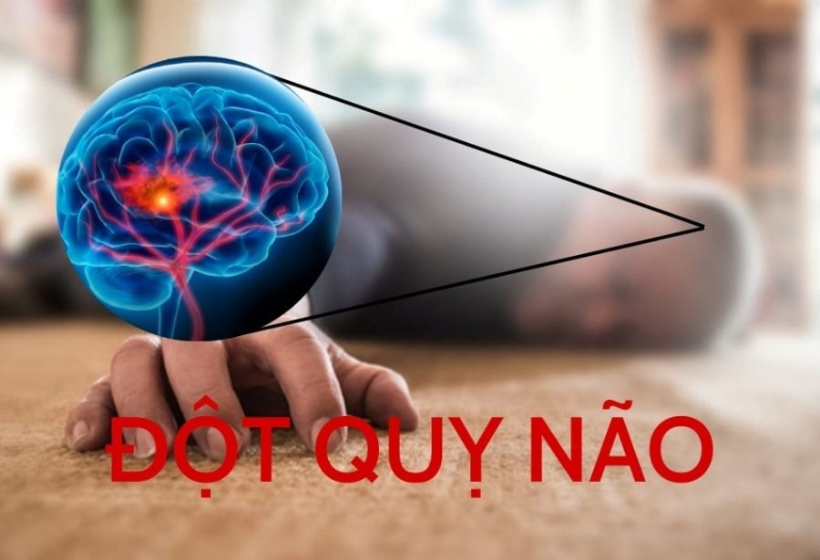 Cảnh báo dấu hiệu đột quỵ não sớm