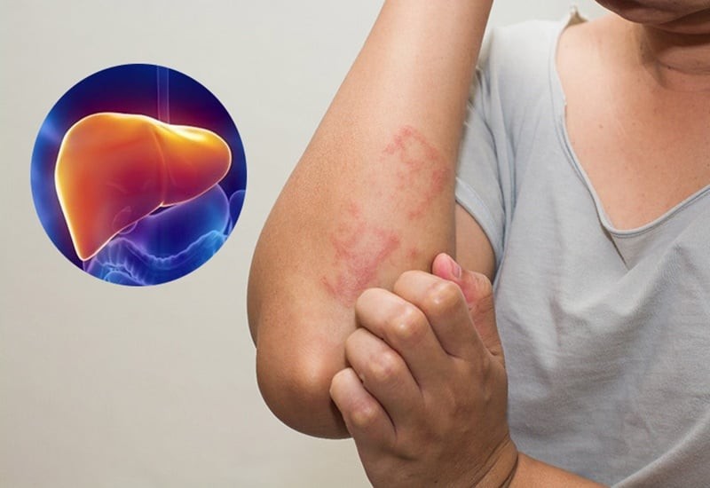 5 dấu hiệu cảnh báo bệnh gan đã đi vào giai đoạn nặng