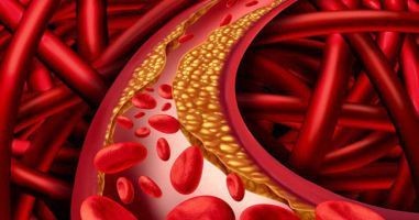 Người gầy cũng đừng chủ quan với bệnh mỡ máu