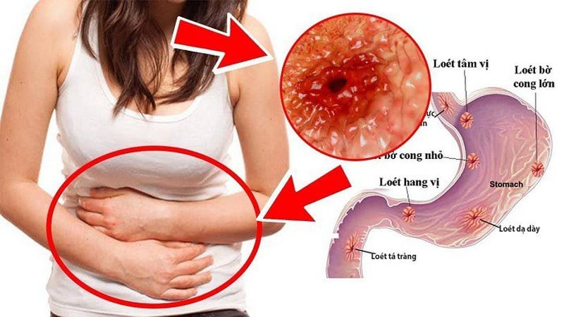 Cảnh báo dấu hiệu ung thư dạ dày