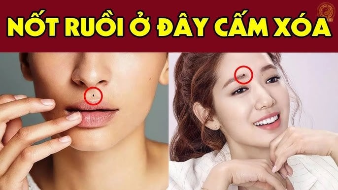 Nốt ruồi may mắn