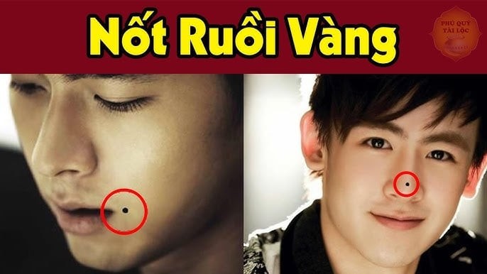 Nốt ruồi hút lộc