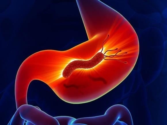 Viêm dạ dày mãn tính có thể chia thành hai thể: nông và teo. T