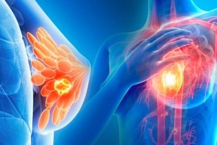 2 thói quen xấu của chồng khiến vợ dễ K vú: Số 1 nhiều người lại thích