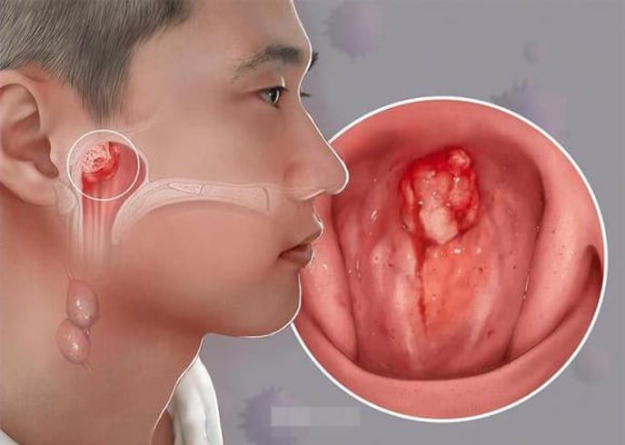7 dấu hiệu K vòm họng: Số 1 không biết sớm khó mà chữa