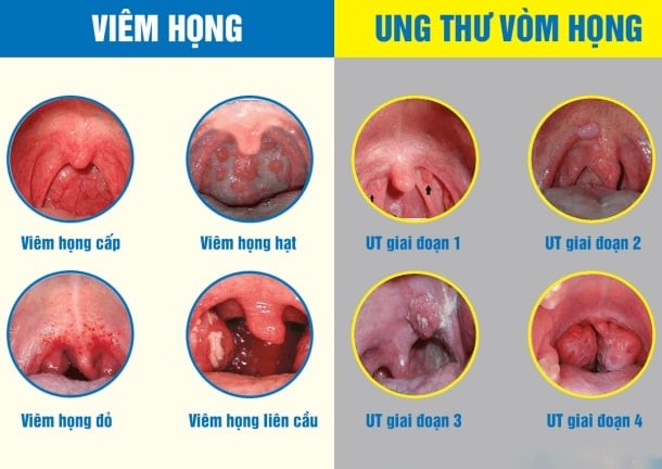Triệu chứng này có thể đi kèm với chảy máu mũi, đặc biệt khi bệnh tiến triển.
