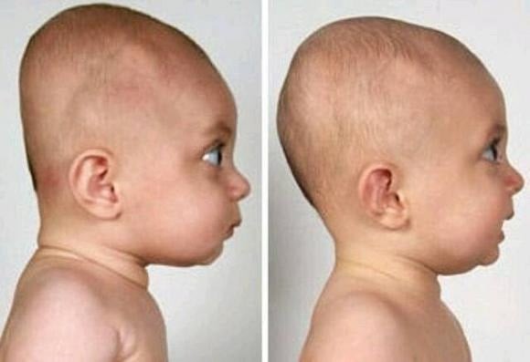 Niềm tin này đã khiến nhiều phụ huynh can thiệp từ rất sớm: cho con nằm gối lõm, điều chỉnh tư thế ngủ, thậm chí bế ẵm theo cách đặc biệt để “nắn” đầu. 