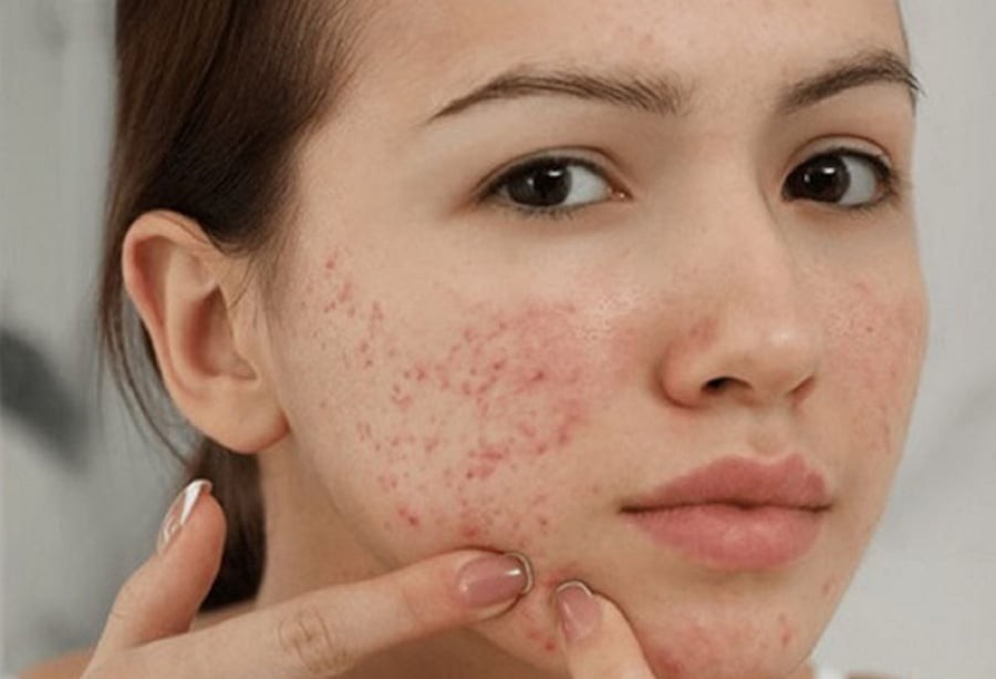 Nếu không rửa mặt, nguy cơ viêm nang lông, viêm da do nấm, thậm chí hình thành mụn mủ