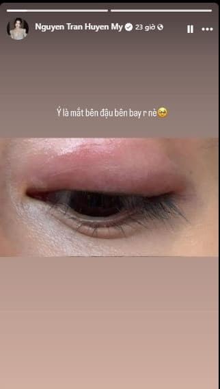 Á hậu Huyền My bị té ngã