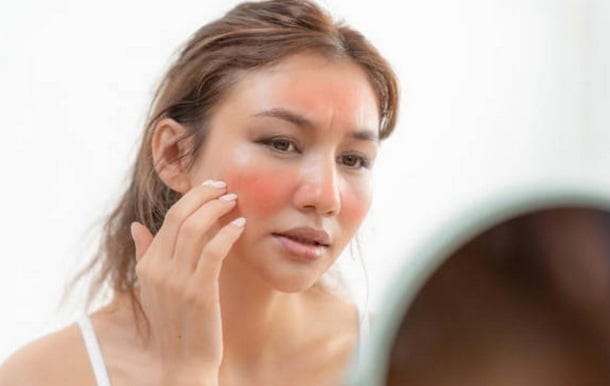 Sau khi làm dịu, cần dùng kem dưỡng ẩm để phục hồi hàng rào bảo vệ da, hạn chế bong tróc và khô nứt.