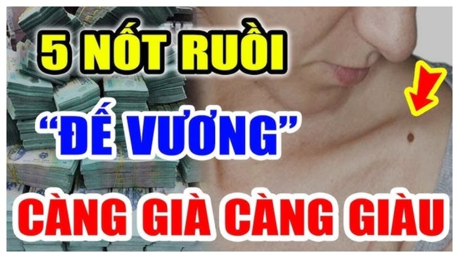 Nốt ruôi may mắn