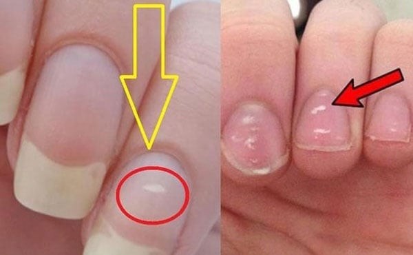 Móng tay có dấu hiệu này là gan đang